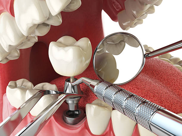 Best Emergency Dental Surgery in Hillsborough, CA